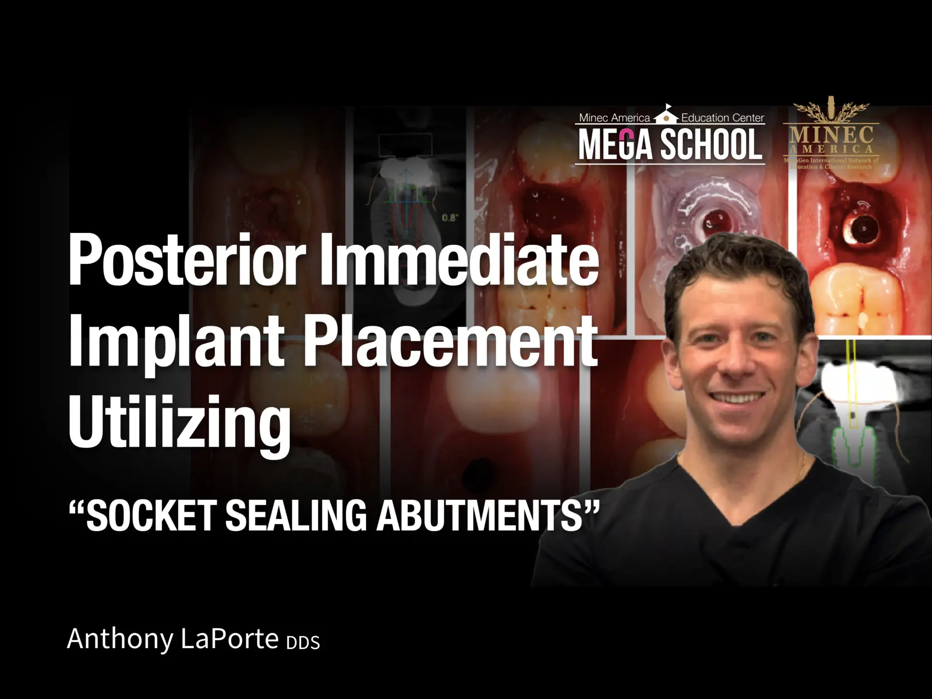Posterior Immediate Implant Placement Utilizing “SOCKET SEALING ABUTMENTS”