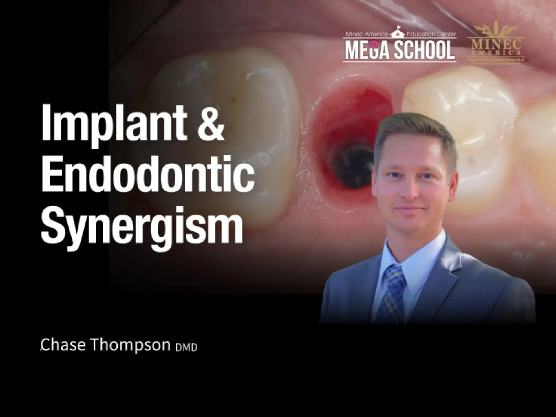 Implant & Endodontic Synergism
