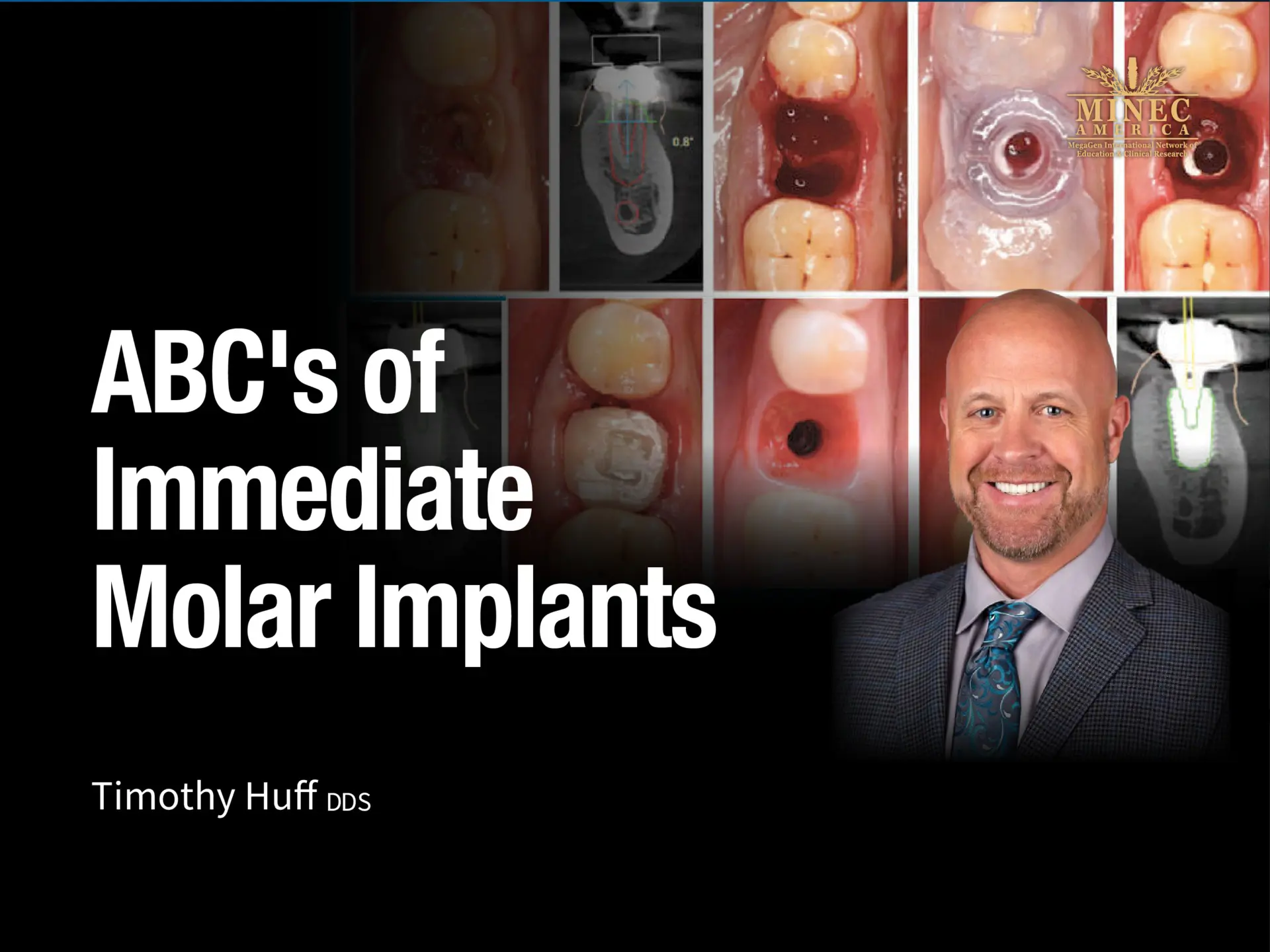 ABC's of Immediate Molar Implants