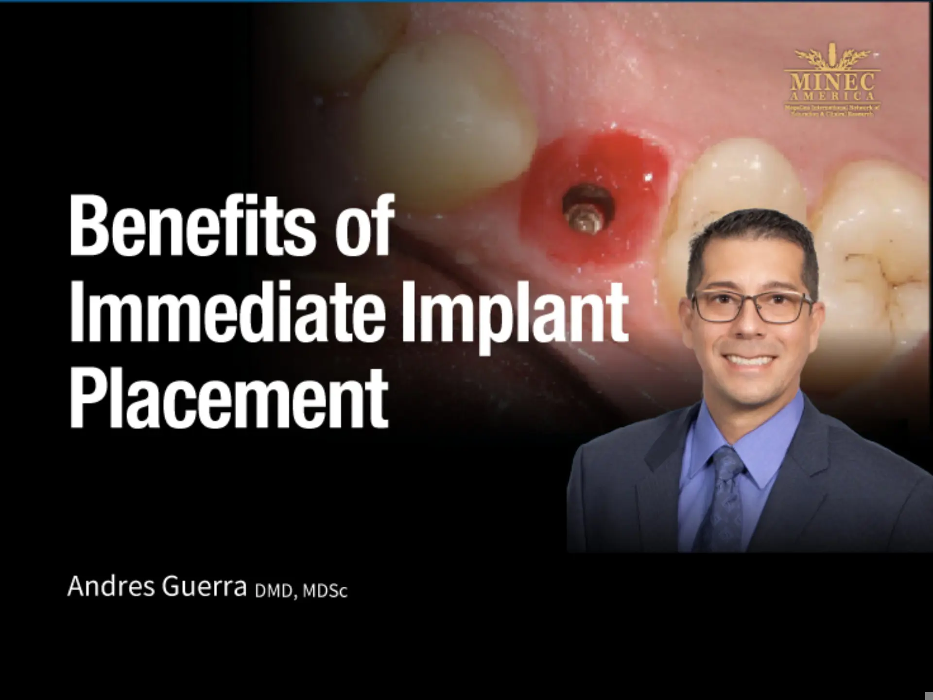 Benefits of Immediate Implant Placement