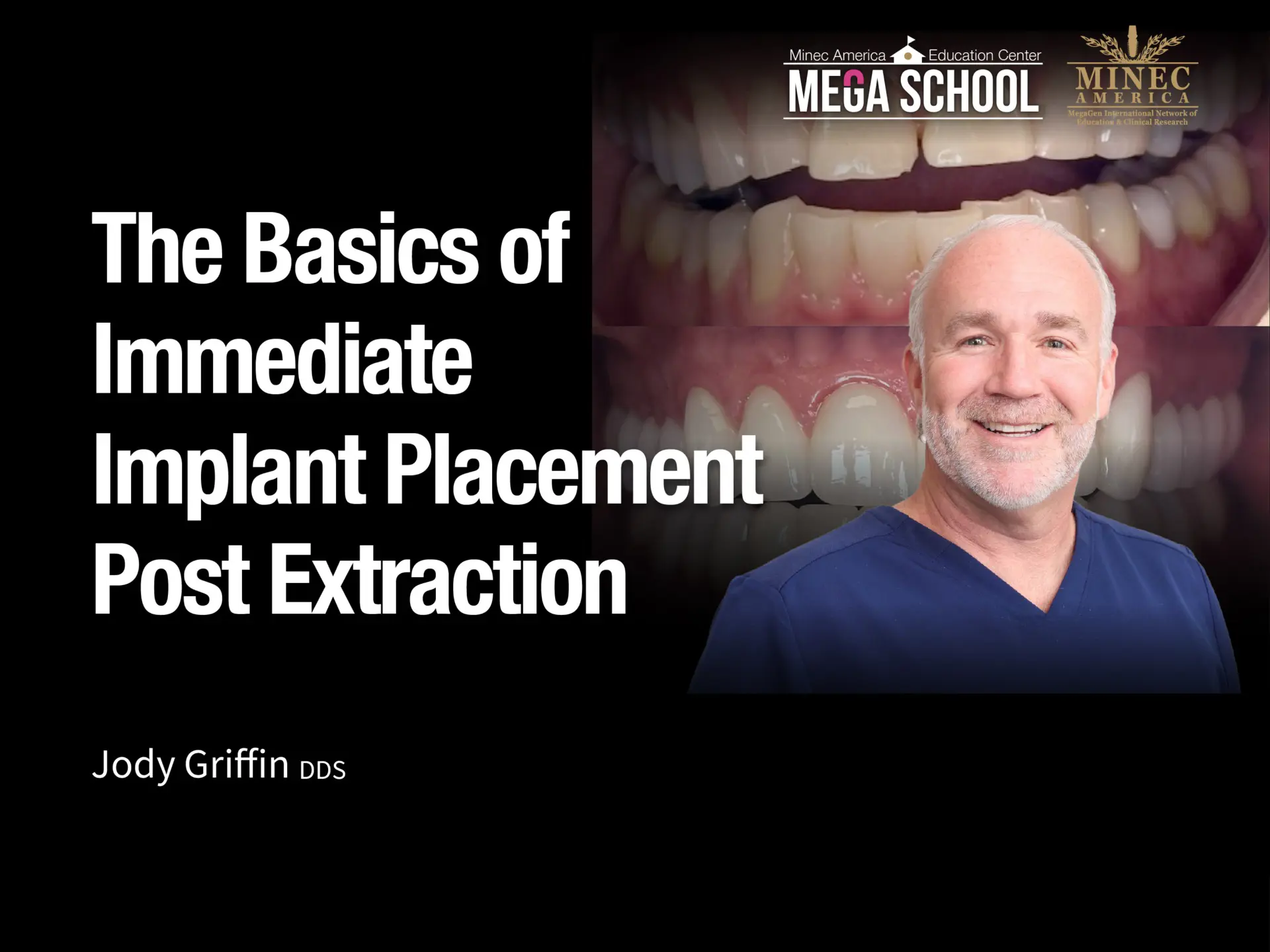 The Basics of Immediate Implant Placement Post Extraction