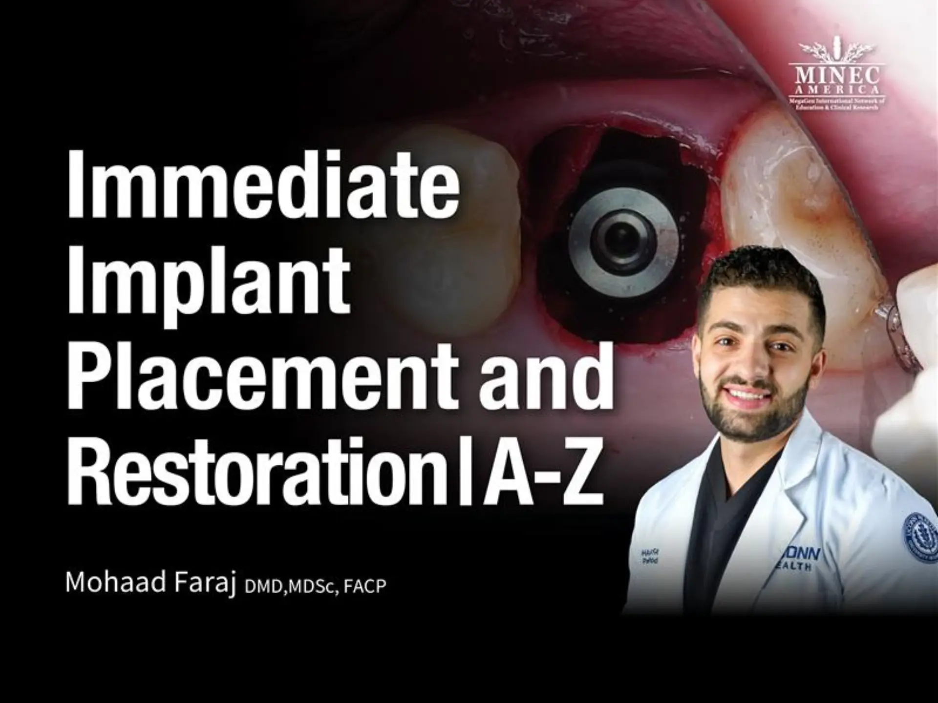 Immediate Implant Placement and Restoration | A-Z