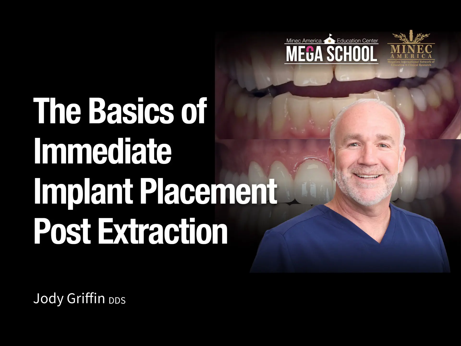 The Basics of Immediate Implant Placement Post Extraction