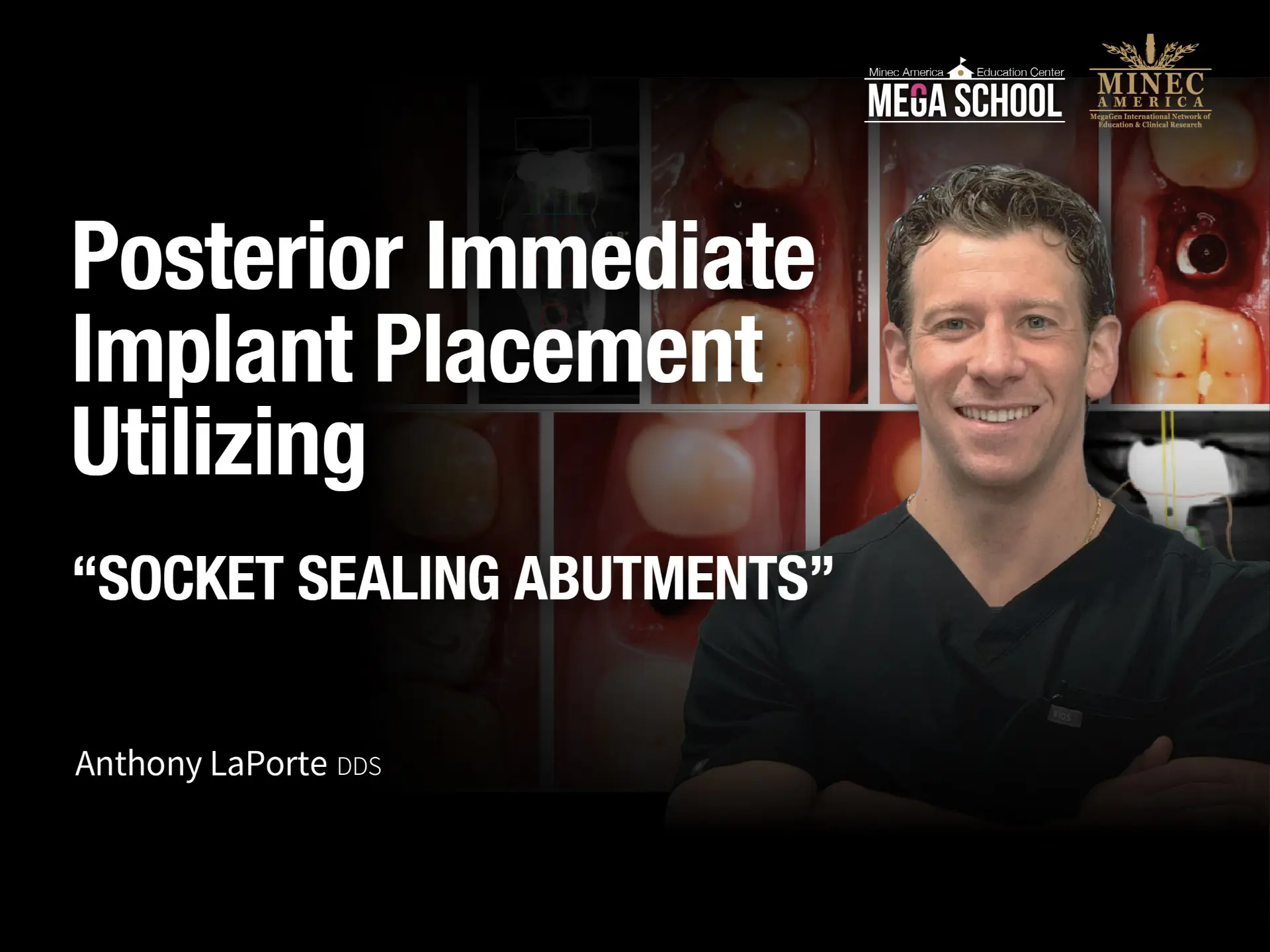 Posterior Immediate Implant Placement Utilizing “SOCKET SEALING ABUTMENTS” - May