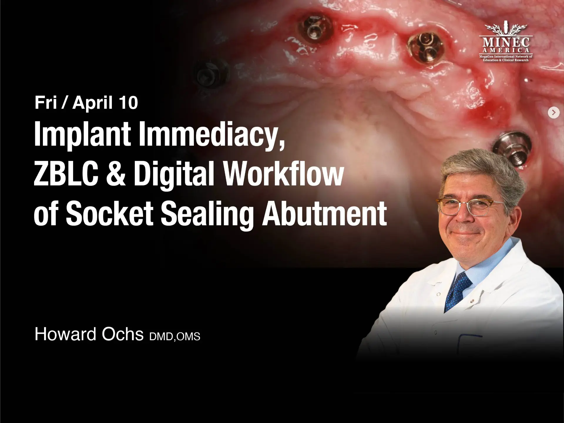 Implant Immediacy, ZBLC & Digital Workflow of Socket Sealing Abutment - April