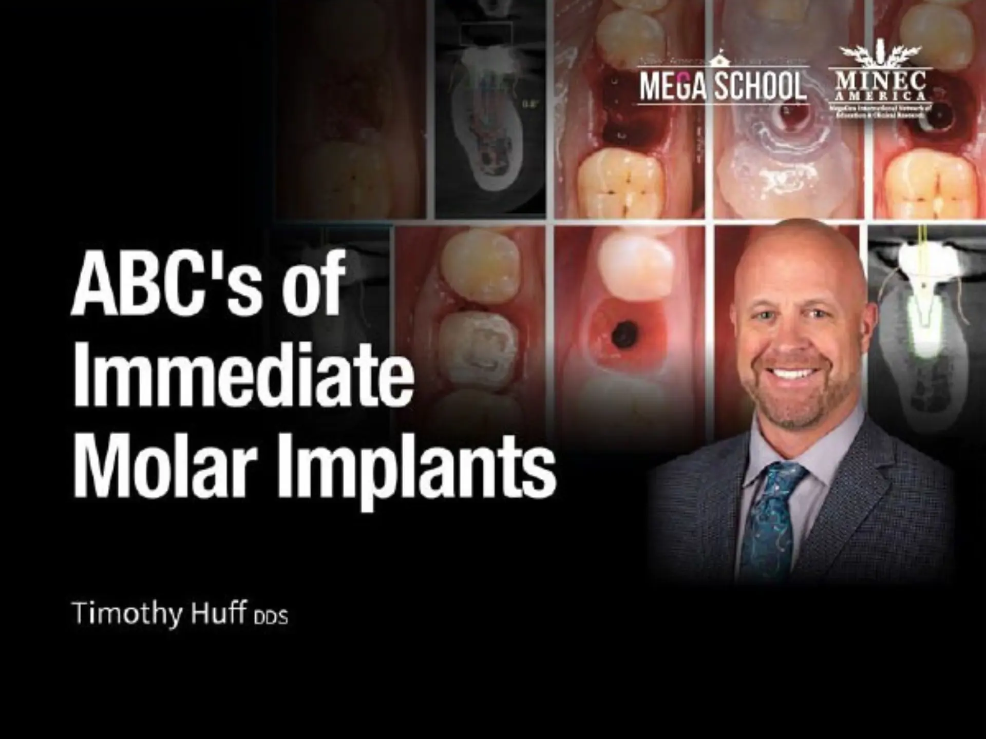 ABC's of Immediate Molar Implants - April