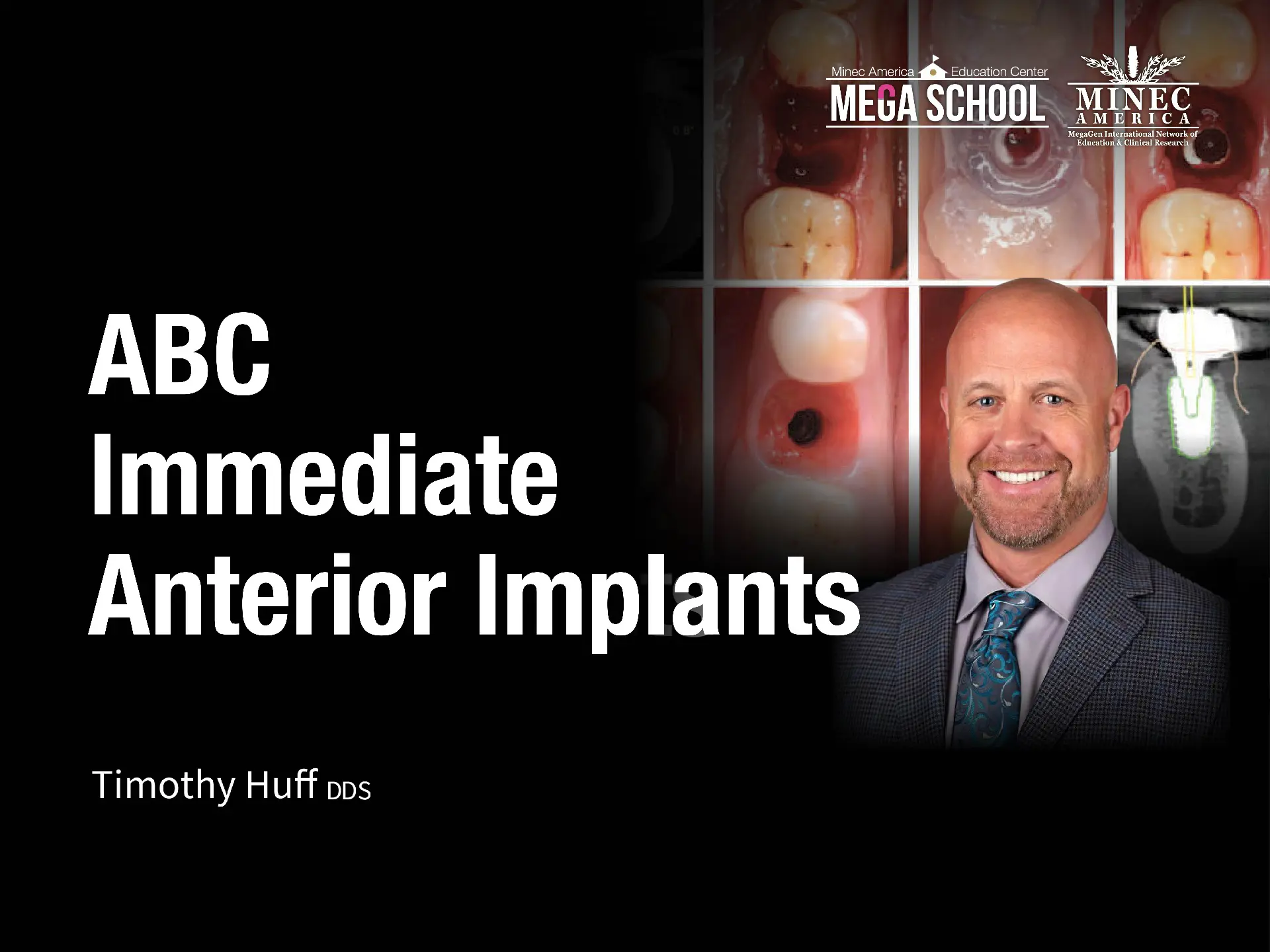 ABC Immediate Anterior Implants - April