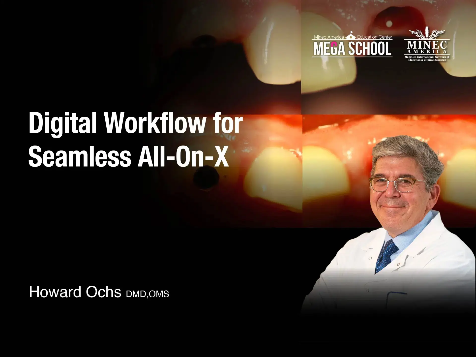 Digital Workflow for  Seamless All-On-X - July