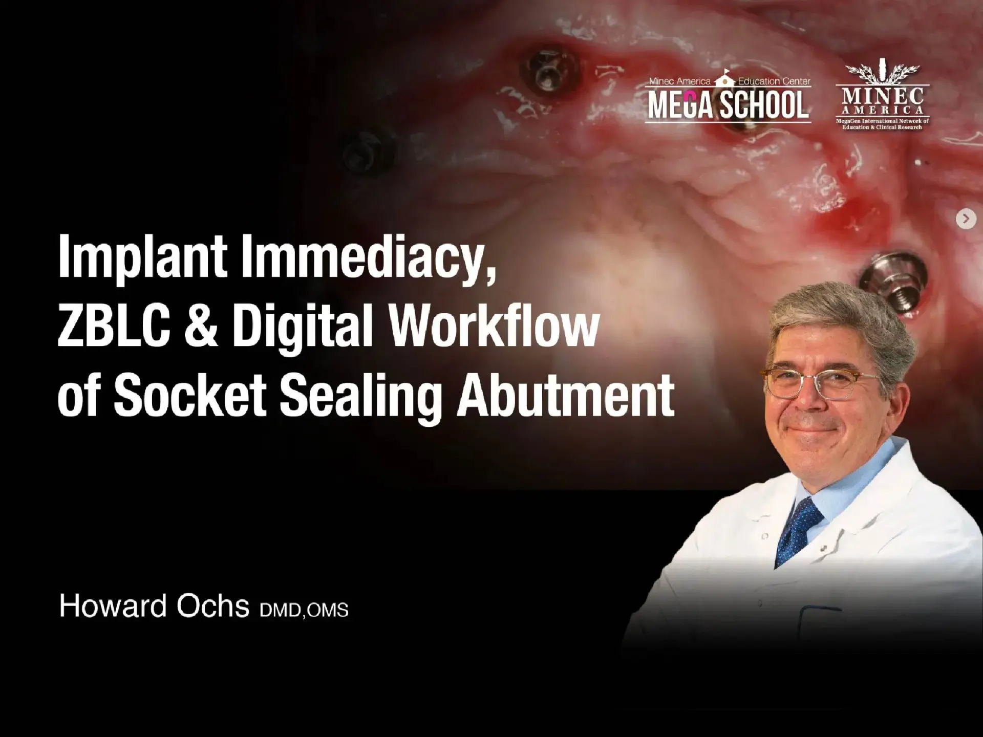 Implant Immediacy, ZBLC & Digital Workflow of Socket Sealing Abutment - July
