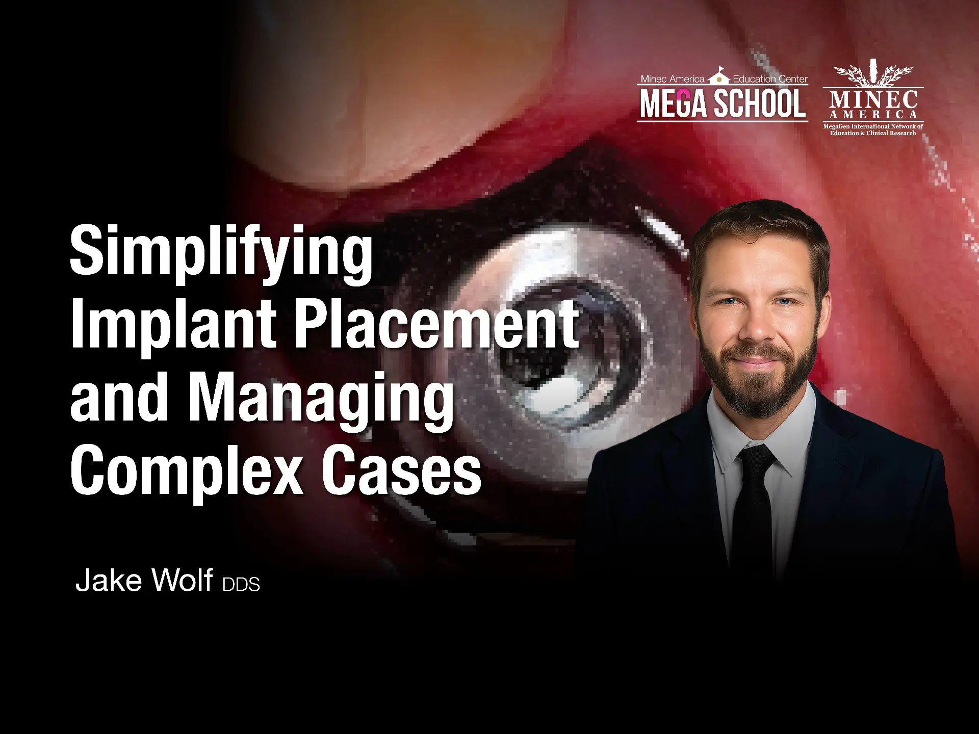 Simplifying Implant Placement, and Managing Complex Cases