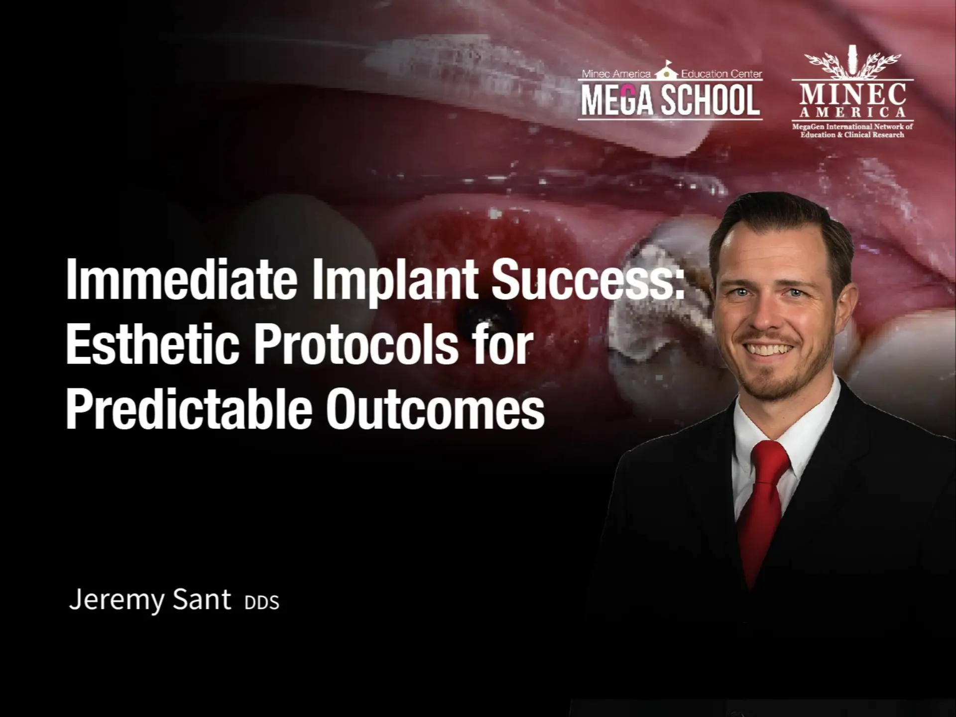 Immediate Implant Success: Esthetic Protocols for Predictable Outcomes