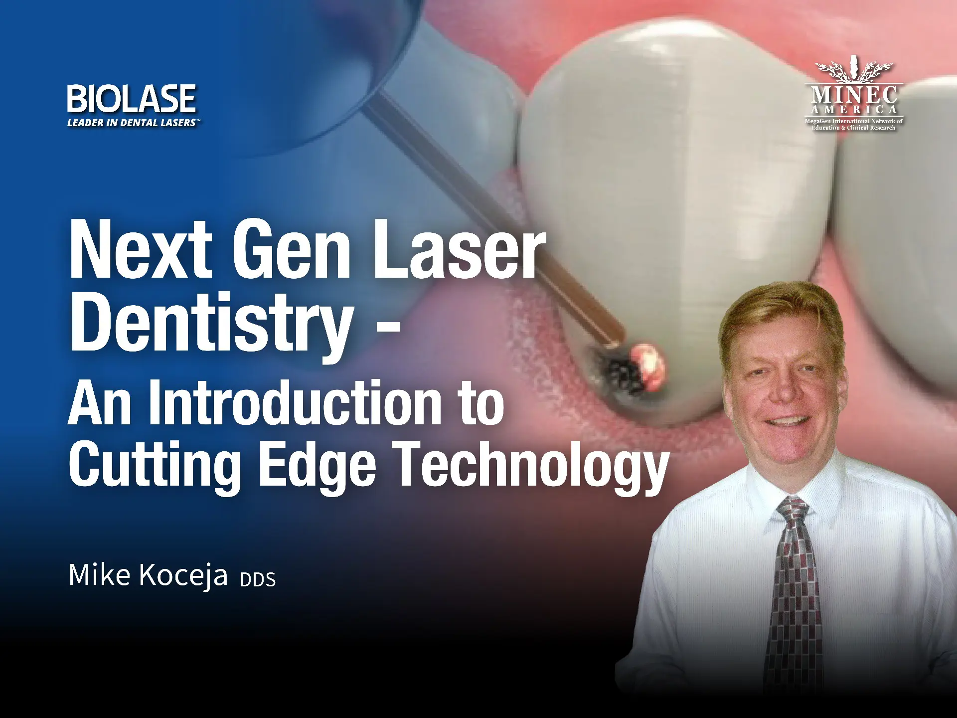 Next Gen Laser Dentistry - An Introduction to Cutting Edge Technology