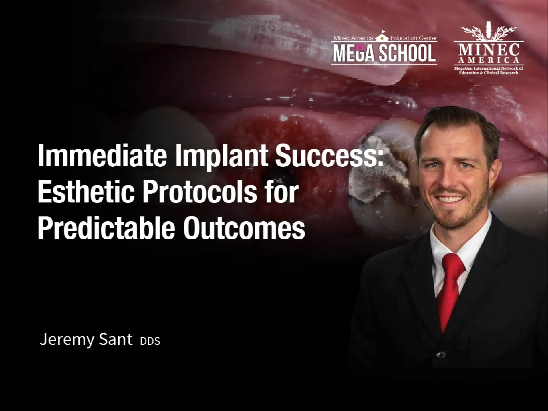 Immediate Implant Success: Esthetic Protocols for Predictable Outcomes