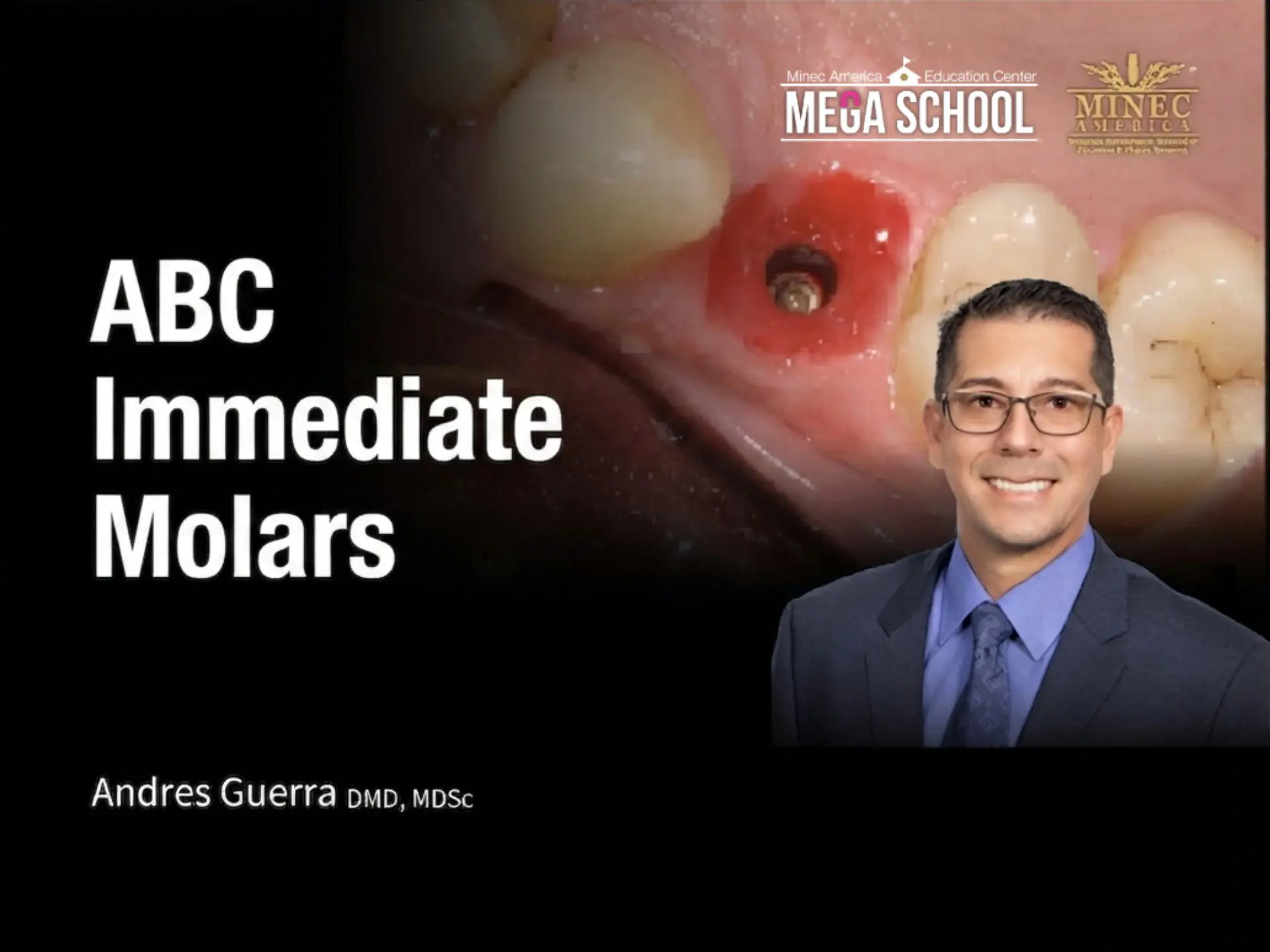 ABC Immediate Molars