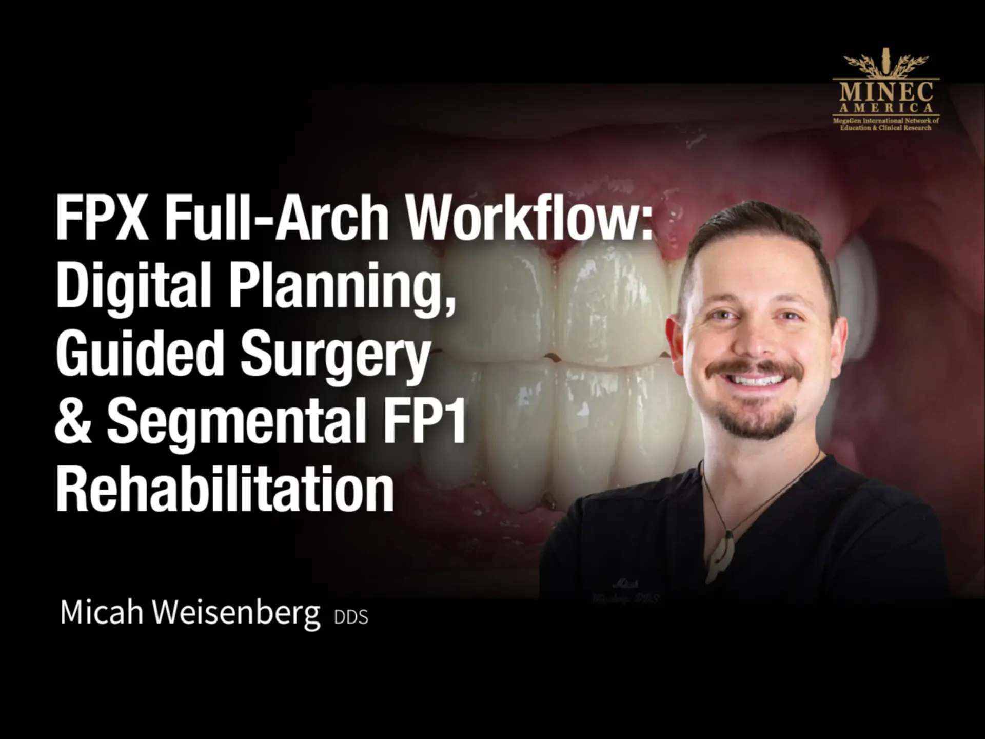 FPX Full-Arch Workflow: Digital Planning, Guided Surgery & Segmental FP1 Rehabilitation
