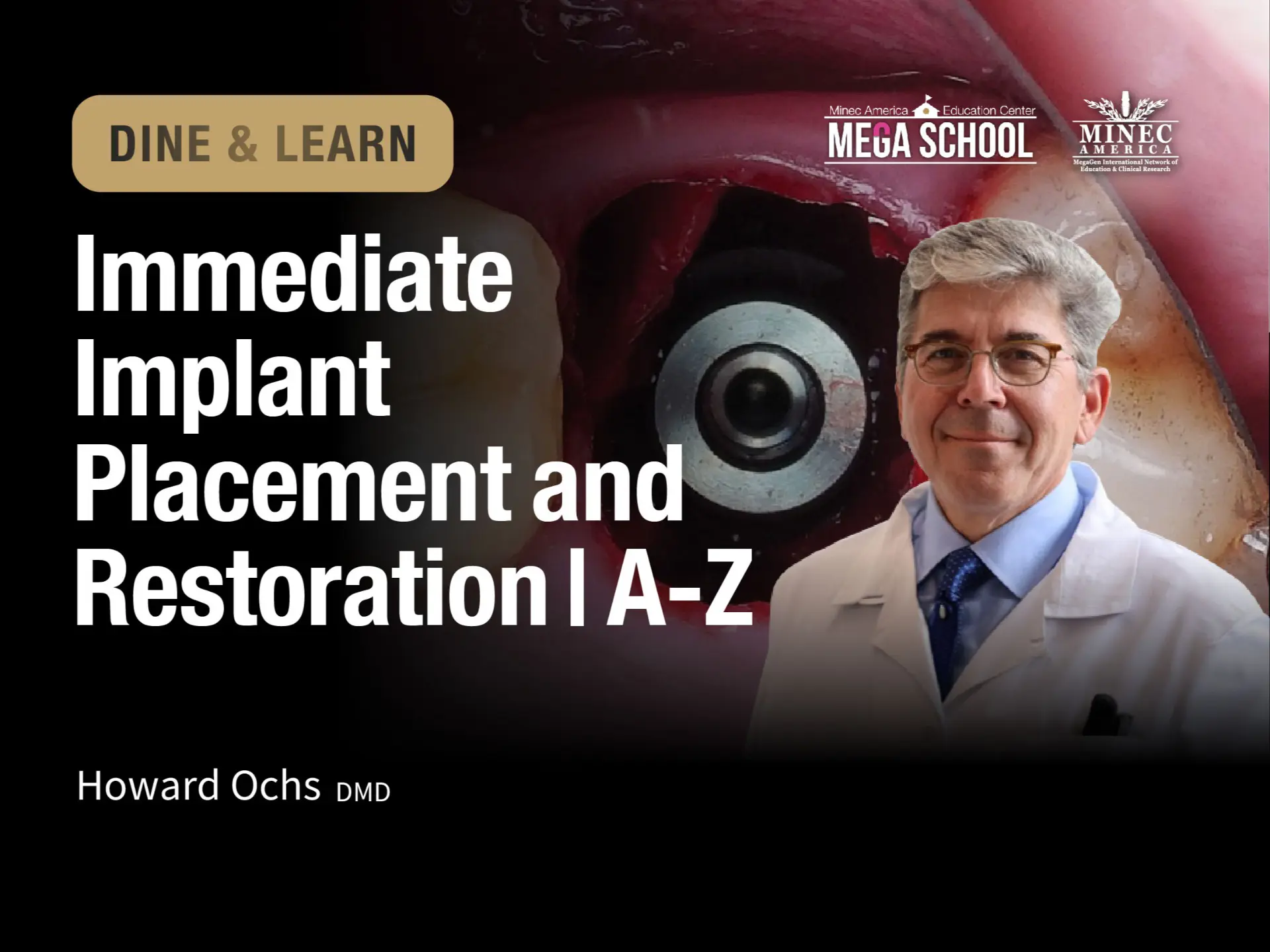 Dine & Learn: Immediate Implant Placement and Restoration | A-Z 