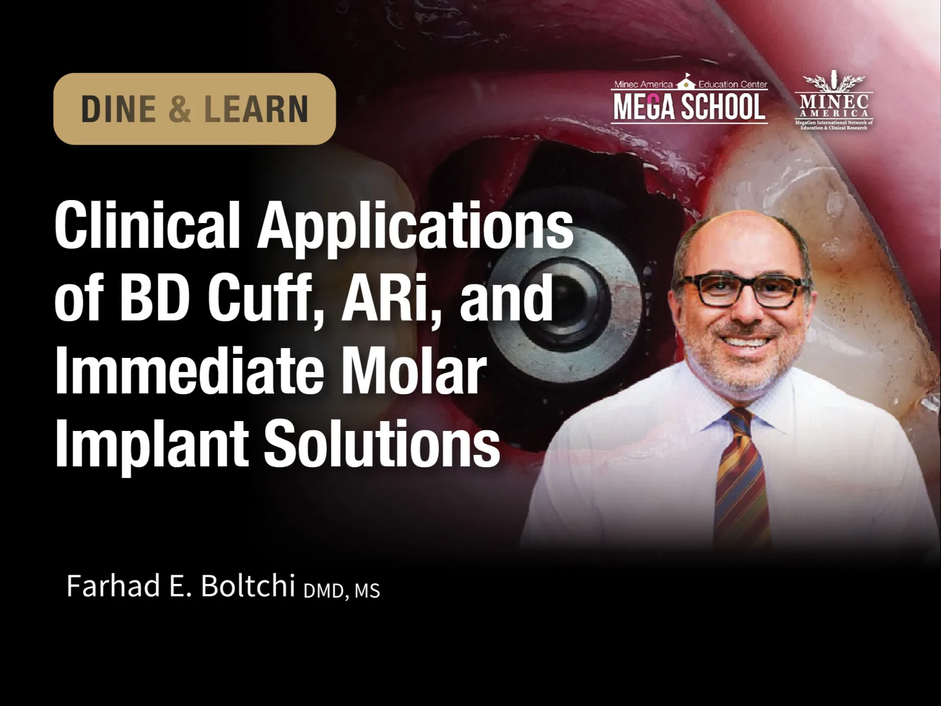 Dine & Learn: Clinical Applications of BD Cuff, ARi, and Immediate Molar Implant Solutions (Irving, TX)