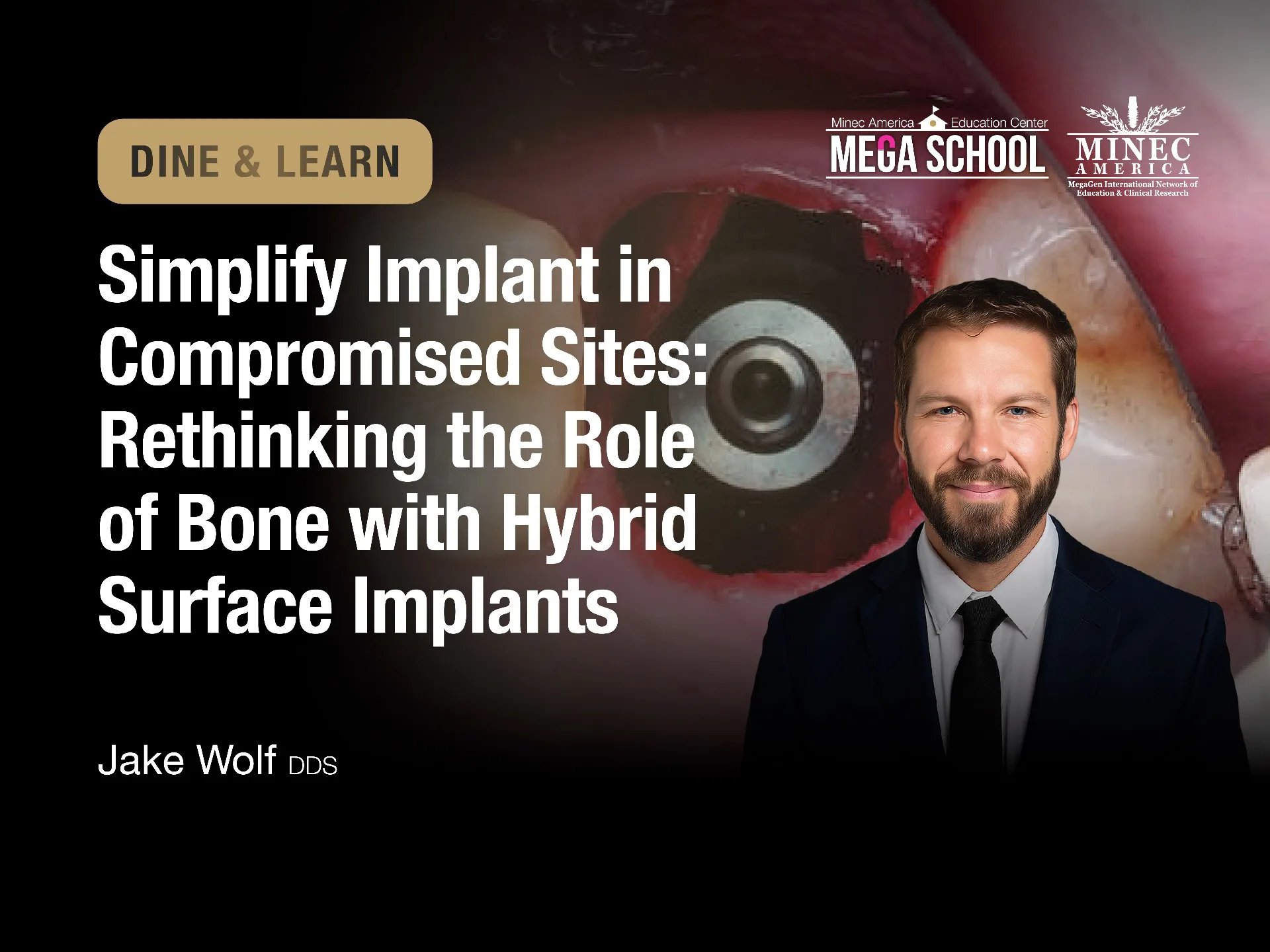 Dine & Learn: Simplify Implant in  Compromised Sites: Rethinking the role  of bone with hybrid surface implants (NJ) 